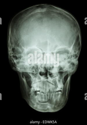 Crâne film(AP) voir antéro-postérieur du crâne humain normal Banque D'Images