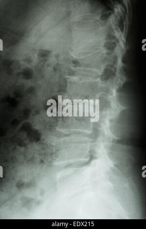 Film x-ray latérale de la colonne lombaire : show burst fracture à la colonne vertébrale lombaire (effondrement à corps de colonne lombaire) Banque D'Images