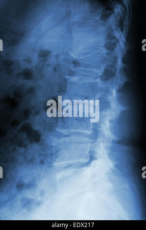 Film x-ray latérale de la colonne lombaire : show burst fracture à la colonne vertébrale lombaire (effondrement à corps de colonne lombaire) Banque D'Images