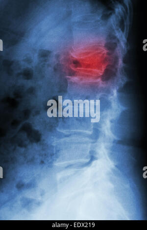 Film x-ray latérale de la colonne lombaire : show burst fracture à la colonne vertébrale lombaire (effondrement à corps de colonne lombaire) Banque D'Images