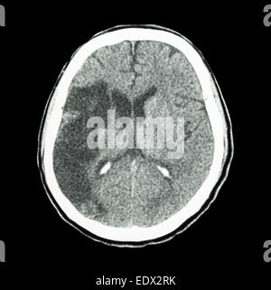 Tc brain : spectacle d'un accident vasculaire cérébral ischémique (hypodensite au-frontal droit lobe pariétal) Banque D'Images