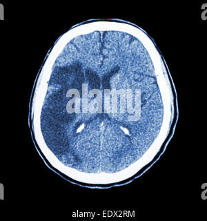 Tc brain : spectacle d'un accident vasculaire cérébral ischémique (hypodensite au-frontal droit lobe pariétal) Banque D'Images