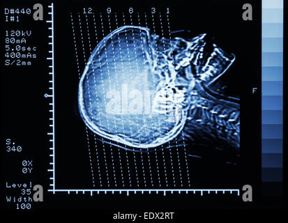 Scanner de film (Computed tomography) cerveau : voir la section sur le crane de ligne Banque D'Images