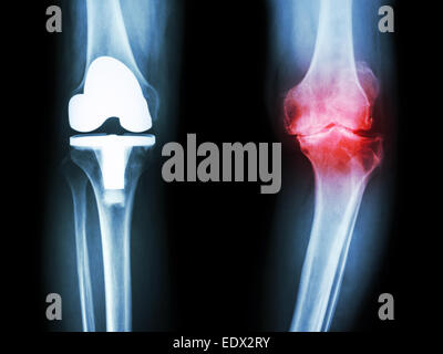 Film x-ray de l'arthrose du genou genou articulation artificielle et patient Banque D'Images