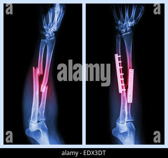 Les fractures de l'os de l'avant-bras. Il a été exploité et fixe interne avec la plaque et vis (image de gauche : avant l'opération , droit im Banque D'Images