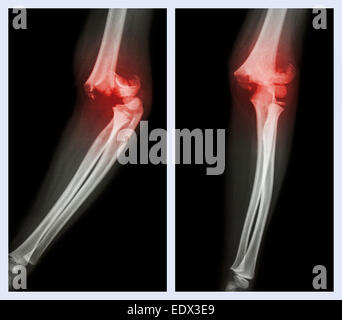 Coude fracture (image de gauche : position latérale , image de droite : poste avant) Banque D'Images