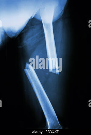 Film X-ray femur gauche(cuisse gauche) montrent une fracture complète du fémur et déplacer l'arbre Banque D'Images