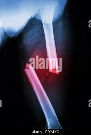 Film X-ray femur gauche(cuisse gauche) montrent une fracture complète du fémur et déplacer l'arbre Banque D'Images