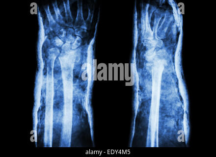 La partie distale du radius fracture (fracture de Pouteau-Colles) et cast (avant et latéraux) Banque D'Images