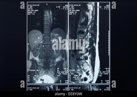 X-ray radiographie du rachis Banque D'Images