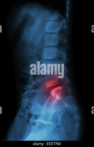 Enfant de la colonne lombaire et inflammation au rachis lombaire ( mal de dos ) ( X-ray - thoracique lombaire ) ( vue latérale ) Banque D'Images