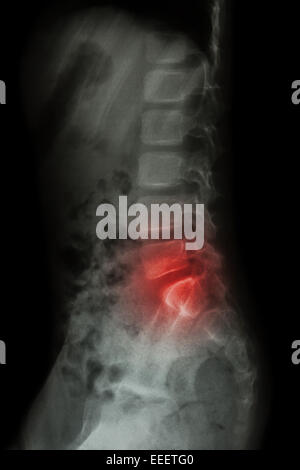 Enfant de la colonne lombaire et inflammation au rachis lombaire ( mal de dos ) ( X-ray - thoracique lombaire ) ( vue latérale ) Banque D'Images