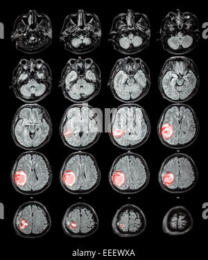Cerveau IRM : tumeur au cerveau au lobe pariétal droit Banque D'Images