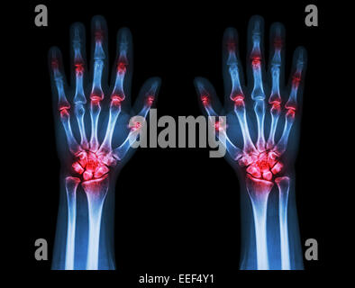 Les deux mains de l'arthrite mixte multiples ( la goutte, le rhumatisme ) sur fond noir Banque D'Images