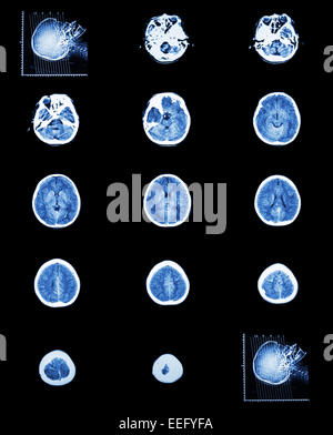 La tomodensitométrie (CT scan) d'un cerveau normal ( système cérébrovasculaire ) Banque D'Images
