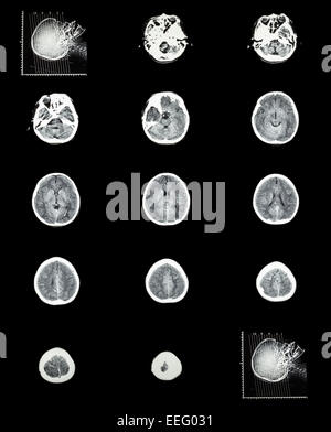 La tomodensitométrie (CT scan) d'un cerveau normal ( système cérébrovasculaire ) Banque D'Images