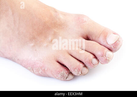 Homme célibataire pied d'eczéma isolé sur fond blanc Banque D'Images