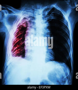 La tuberculose pulmonaire . La radiographie du thorax : atélectasie pulmonaire droite et à l'infiltration et pleural due à Mycobacterium tuberculosis Banque D'Images