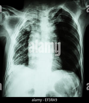 La tuberculose pulmonaire . La radiographie du thorax : atélectasie pulmonaire droite et à l'infiltration et pleural due à Mycobacterium tuberculosis Banque D'Images