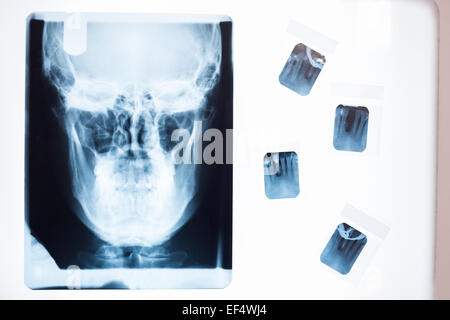 Frais d'un x-ray d'un crâne humain Banque D'Images