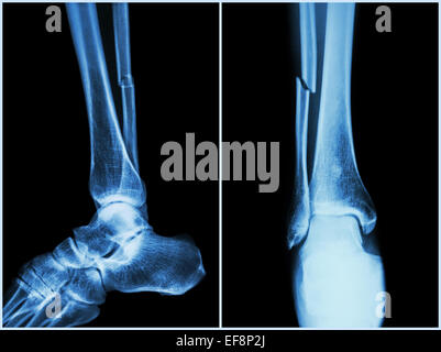 L'arbre de la fracture du péroné jambe os ( ) . X-ray de jambe ( position 2 : Vue de face et de côté ) Banque D'Images