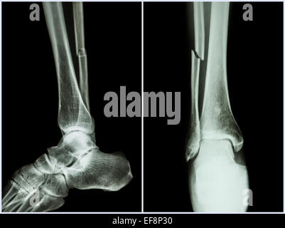 L'arbre de la fracture du péroné jambe os ( ) . X-ray de jambe ( position 2 : Vue de face et de côté ) Banque D'Images