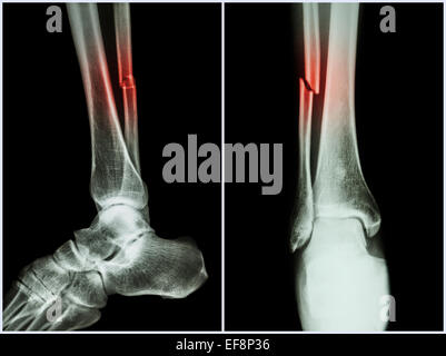 L'arbre de la fracture du péroné jambe os ( ) . X-ray de jambe ( position 2 : Vue de face et de côté ) Banque D'Images