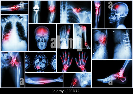 Collection X-ray cérébraux multiples fractures, l'arthrose, la pneumonie, la tuberculose, la spondylose ,,spondylolisthésis ,rendez-vous Banque D'Images