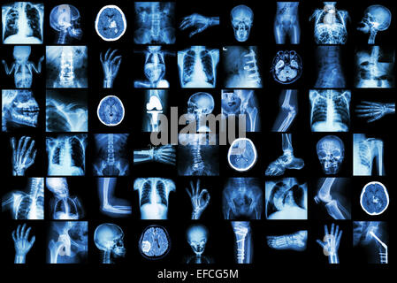 X-ray plusieurs partie de l'adulte et l'enfant et la maladie Tuberculose pulmonaire ( pierre de rein avc arthrose fracture de bow Banque D'Images