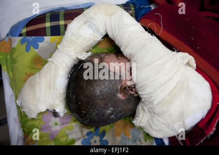 Dhaka, Bangladesh. 5 Février, 2015. Rakib, 12, un travail des enfants, l'une des victimes de l'essence sur un bus cris de douleur quand il reçoit un traitement à la Dhaka Medical College Hospital à Dhaka, Bangladesh, le Jeudi, Février 5, 2015. Les attaquants ont lancé des bombes au feu de pétrole brut d'un bus rempli Mercredi, l'incident s'est produit dans la zone Gazipur. La bombe incendiaire a été signalé sur l'Gazipur autour de 20h30 au milieu des transports et la BNP blocus grève nationale. Cinq personnes dont deux enfants ont été blessés, tous d'entre eux ont été brûlés au milieu d'une grève nationale appelée par l'opposition. © ZUMA Pr Banque D'Images