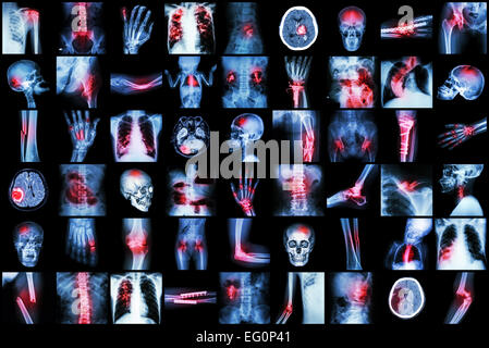 X-ray plusieurs maladies des enfants et des adultes ( cp , Arthrite , Fracture , Tuberculose , tumeur au cerveau , d'une obstruction intestinale , Ki Banque D'Images