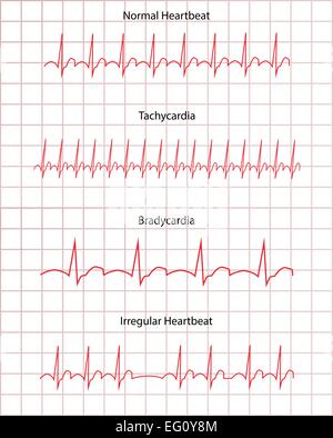 Pathologie ECG EKG Illustration de Vecteur