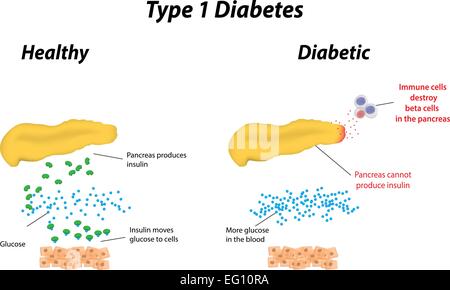 Diabète de type 1 Illustration de Vecteur