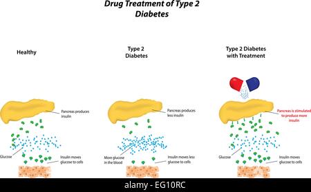 Le traitement médicamenteux du diabète de type 2 Illustration de Vecteur