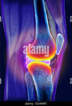 Ménisque, domaine de la douleur, la tomographie par ordinateur Banque D'Images