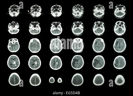 L'accident vasculaire cérébral hémorragique et ischémique Accident vasculaire cérébral . CT scan de cerveau : l'hémorragie intracérébrale ( 3 colonne de gauche) , l'infarctus cérébral ( 3 Banque D'Images