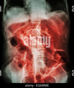 L'obstruction intestinale ( X-ray abdomen dos : gros intestin se dilatent en raison d'une occlusion intestinale due au cancer du colon) Banque D'Images