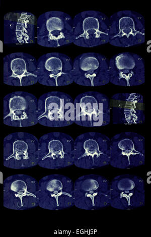 Vertèbre lombaire, hernie discale, d'imagerie de coupe, illustration Banque D'Images