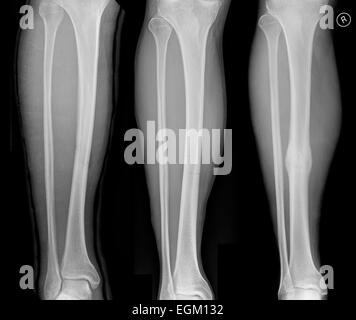 Une séquence montrant une fracture simple du tibia montrant de gauche à droite Jour 1, 65 jours et 107 jours post-traumatiques montrant les os c Banque D'Images