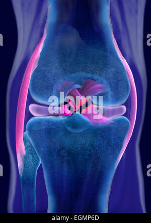 La rupture des ligaments croisés du genou, les deux, illustration Banque D'Images