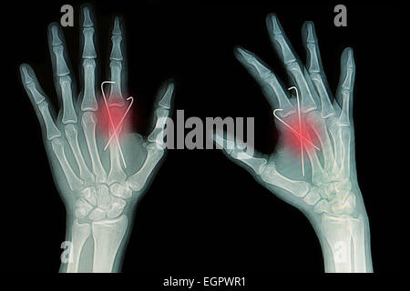 Film x-ray de fracture de la main : voir os métacarpien fracture insérer avec k-fil (Kirschner wire) Banque D'Images