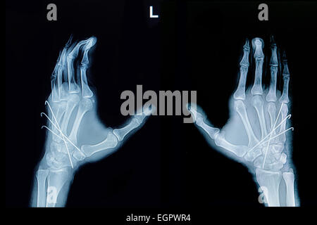 Film x-ray de fracture de la main : voir os métacarpien fracture insérer avec k-fil (Kirschner wire) Banque D'Images