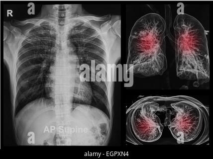 Les radiographies en vertu de l'image 3D ,poumons image 3D Banque D'Images