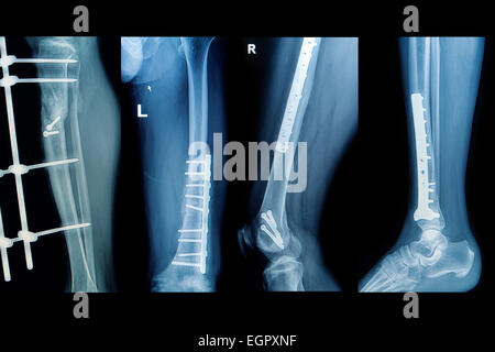 Collection x-rays de droit des droits de l',voir des membres inférieurs fracture de l'implant avec Banque D'Images
