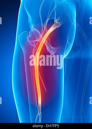 La sciatique, artwork Banque D'Images