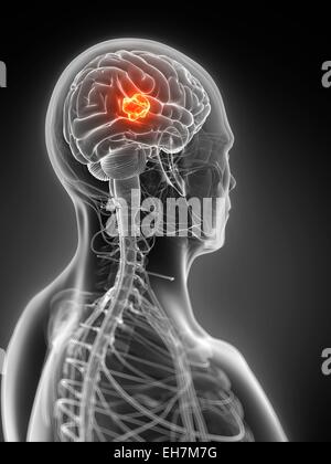 Tumeur au cerveau humain, illustration Banque D'Images