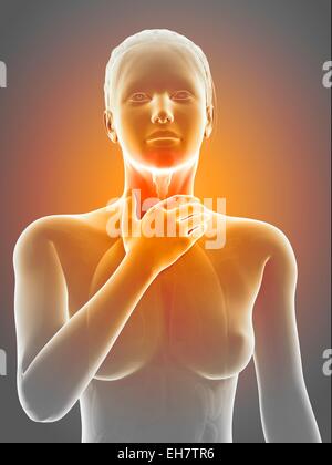 L'inflammation du larynx, illustration Banque D'Images