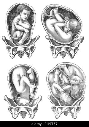 La naissance, les différentes positions de l'enfant à la naissance, conseiller de la santé, 19e siècle, Banque D'Images