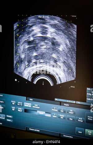 La radiothérapie du cancer de la prostate chirurgie. Le radiologue de l'insertion d'une aiguille creuse à travers une grille modèle (carré noir) et d'un patient à travers la peau du périnée, lors d'un traitement pour le cancer de la prostate. Institut Montsouris, Paris, France. Banque D'Images