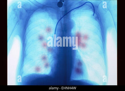 Le cancer du poumon secondaire. X-ray de couleur d'un patient de cancer métastatique (secondaire) Le cancer du poumon . Banque D'Images